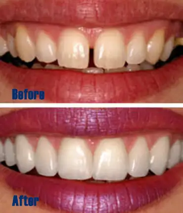 root-canal-treatment-in-erode