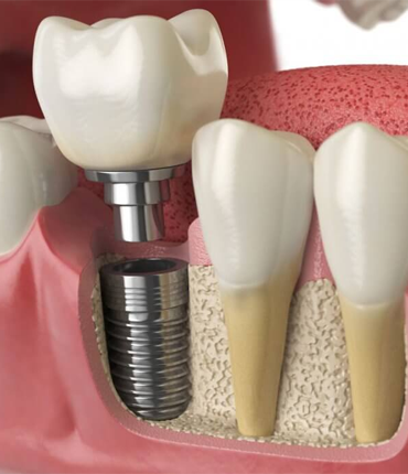 gum-disease-treatment-in-erode